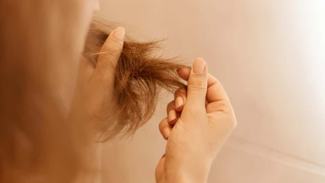 Dandruff Hair Loss