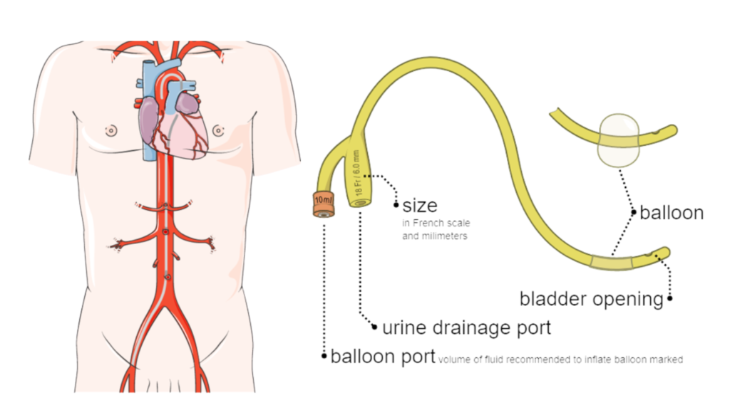 Urinary Catheterization 