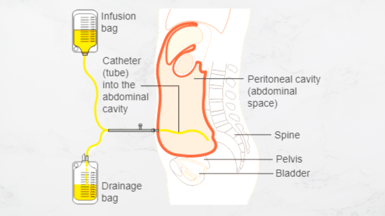 nurses Urinary Catheterization